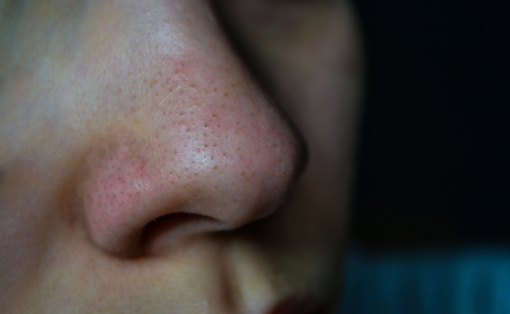 毛穴汚れの原因と改善方法 Wasser バッサ 公式通販サイト